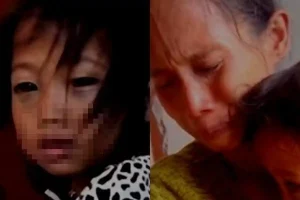 Ibu Laporkan Guru ke Polisi, Ternyata Mata Siswi SD Lebam Bukan Dianiaya: Sakit Batuk